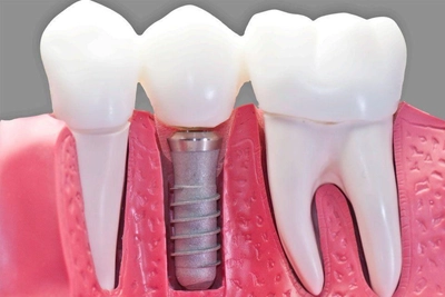 Dental implant